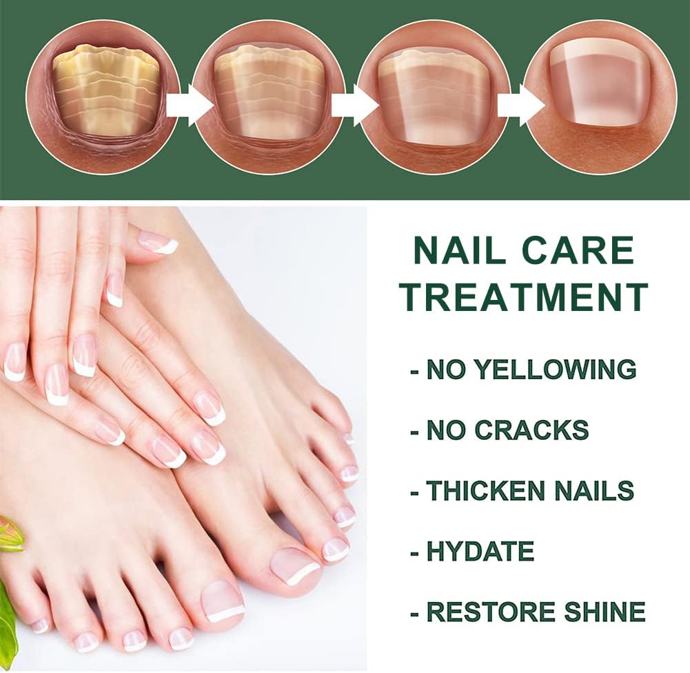 Fast Nail Fungus Remover