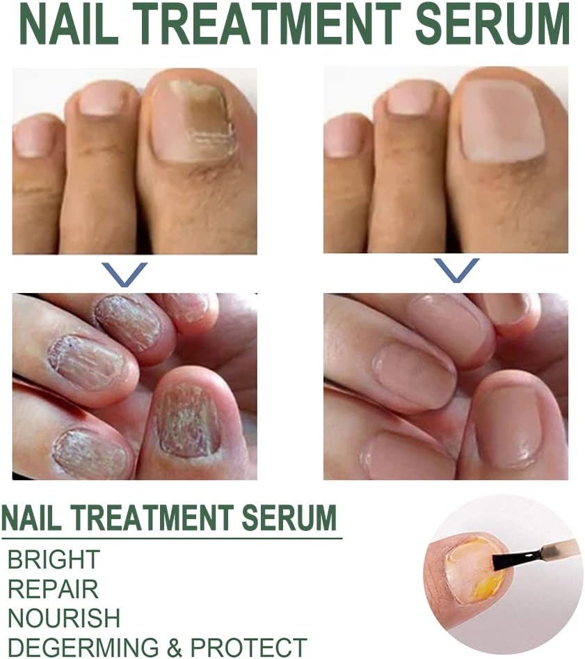 Fast Nail Fungus Remover